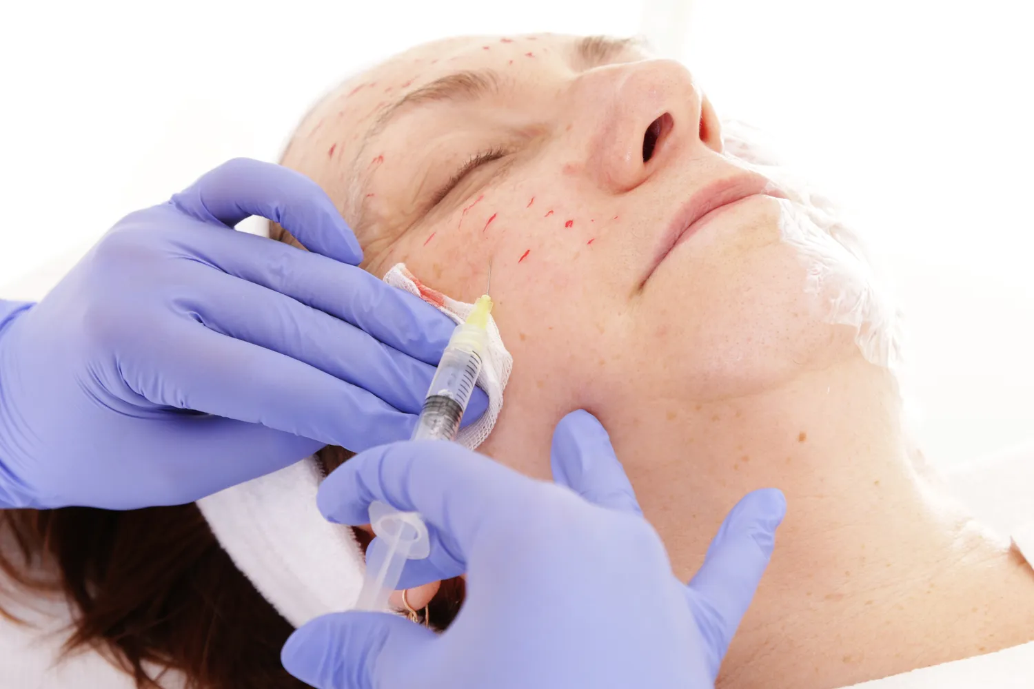 Botoks kiedy efekty?