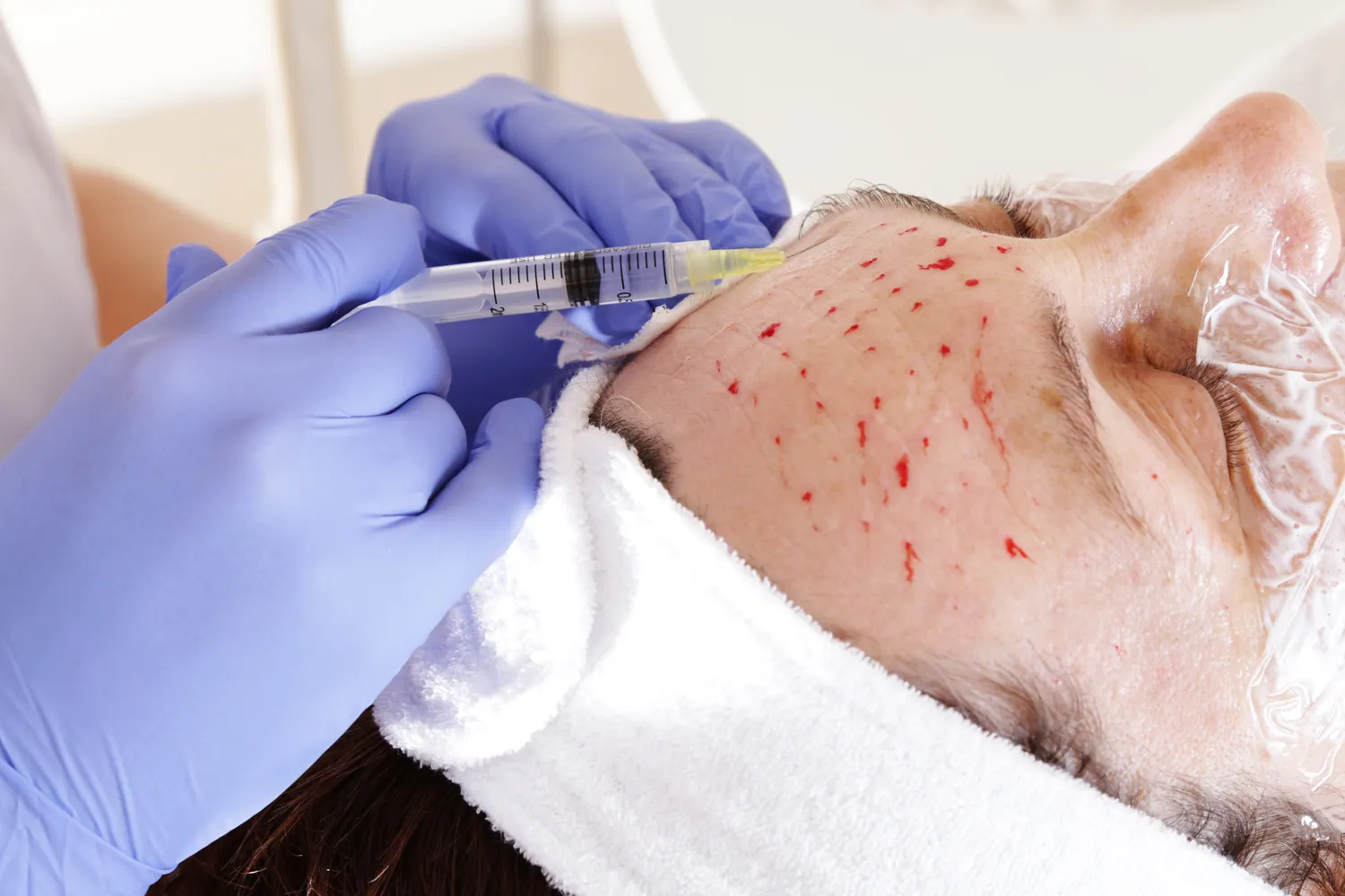 Ile kosztuje kwas hialuronowy w kolano?