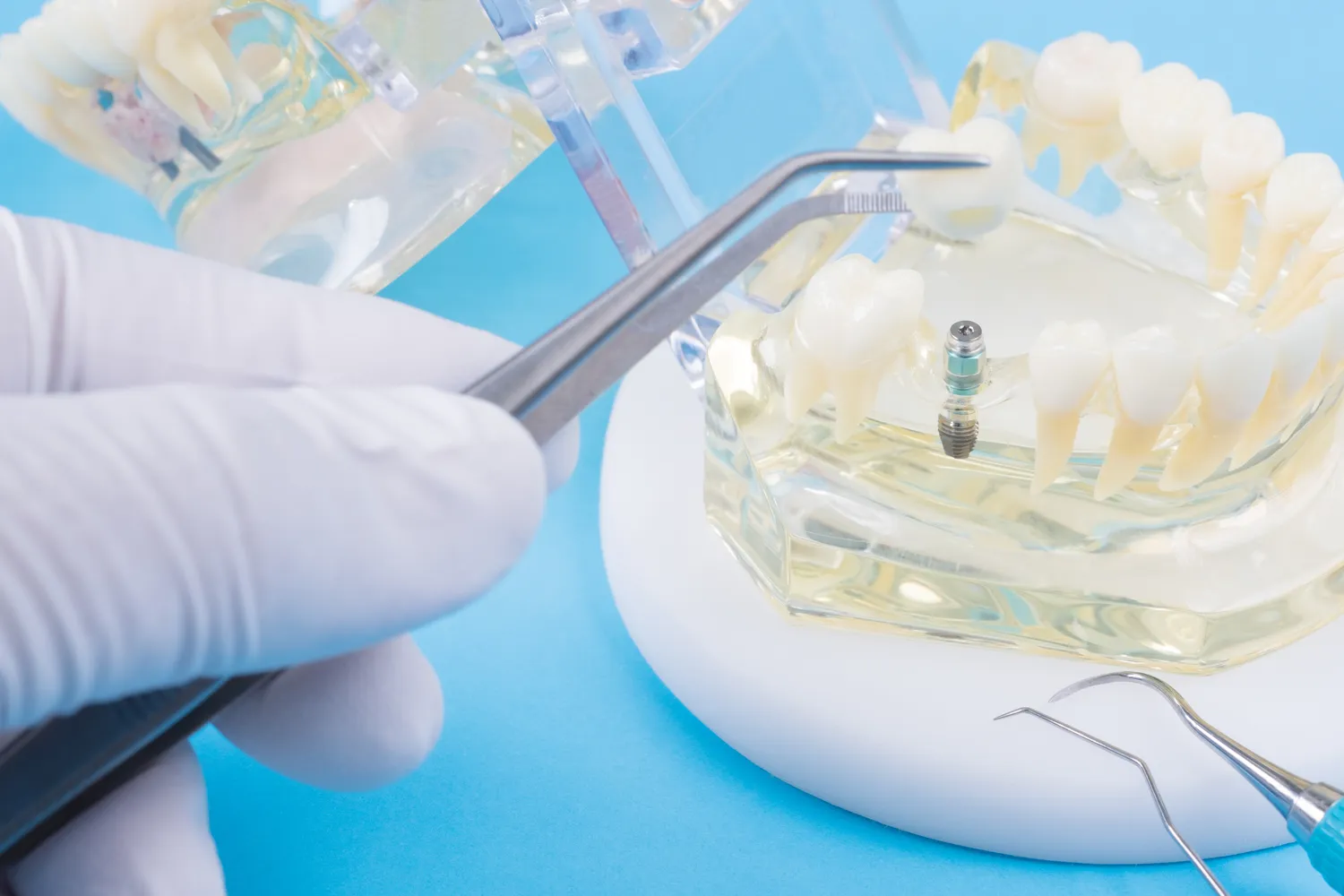 Leczenie kanałowe czy boli?